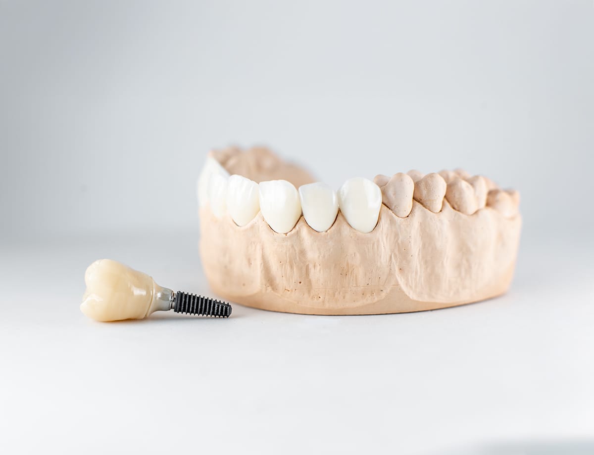 paslauga_Klinika-Šypsena-dantų-implantacija