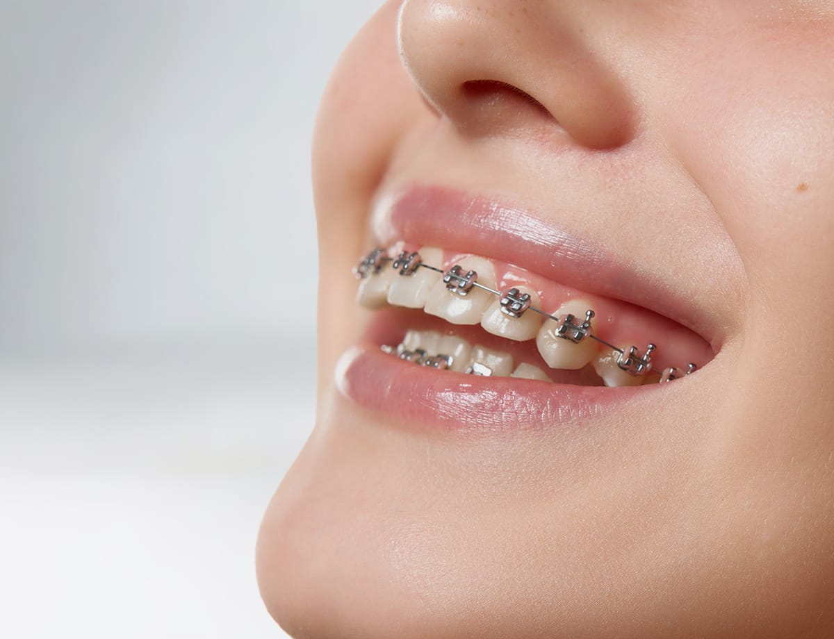 paslauga Klinika Sypsena dantu tiesinimas ortodontinis gydymas breketai