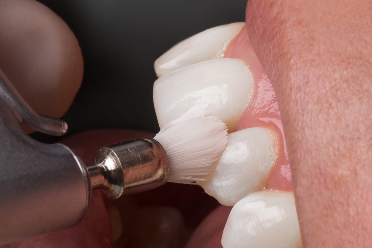 klinika sypsena burnos higiena