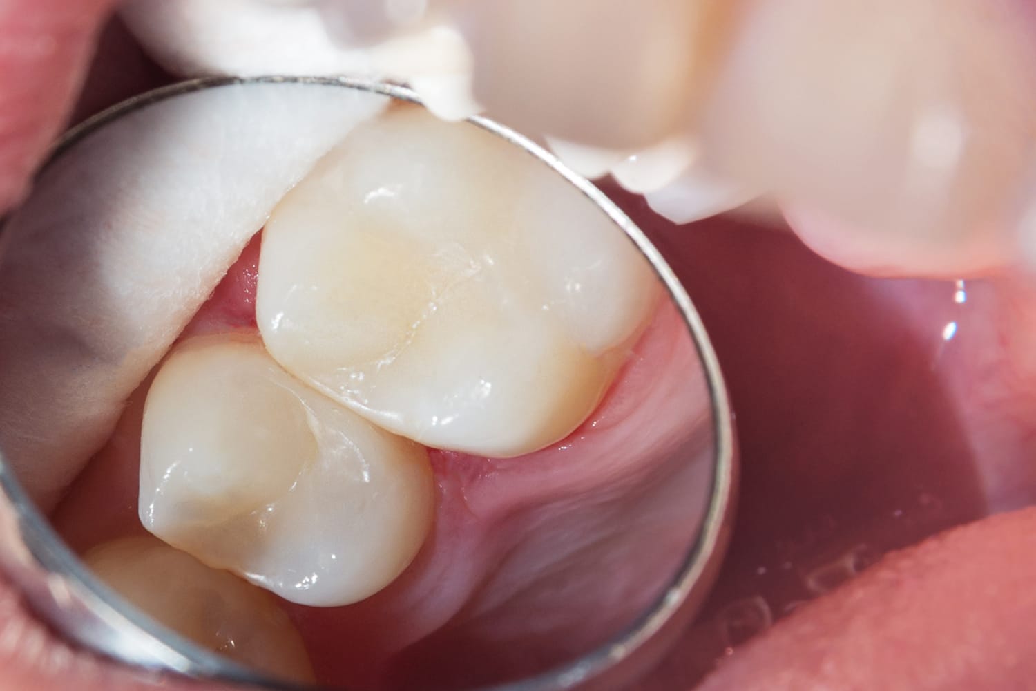 klinika sypsena terapinis dantu plombavimas eduonies gydymas