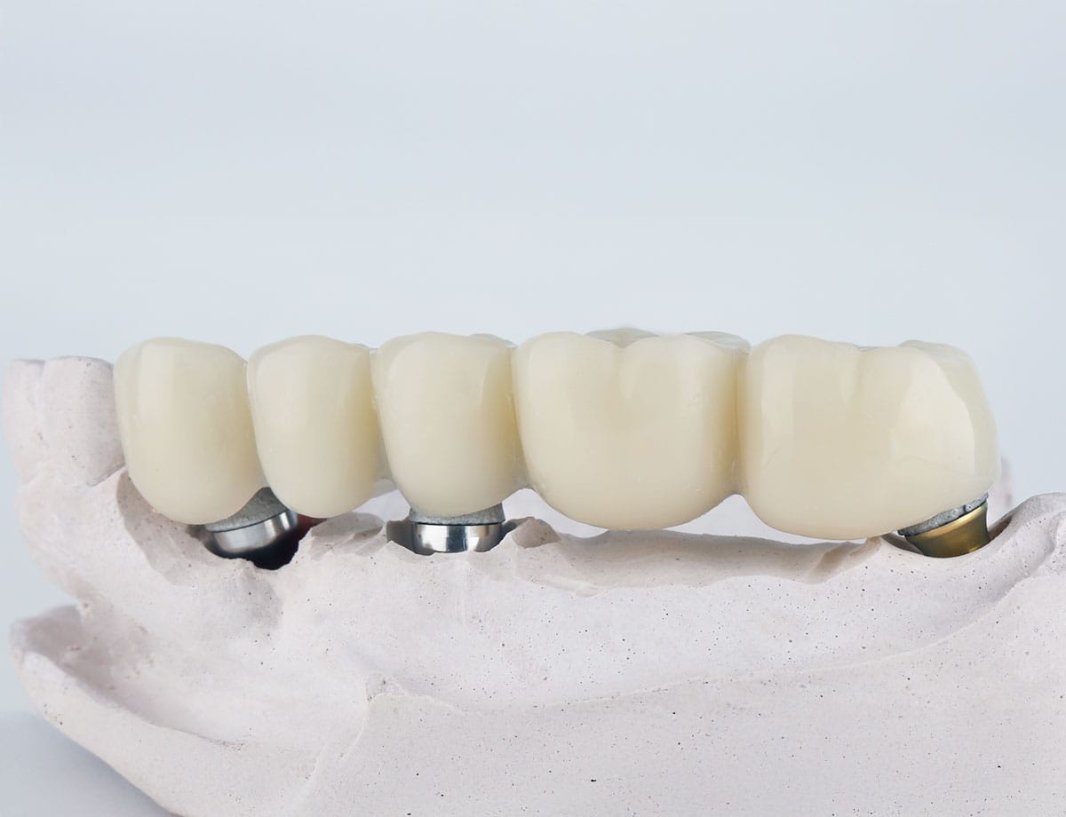 paslauga Klinika Sypsena protezavimas vainikeliai tiltiniai protezai karuneles