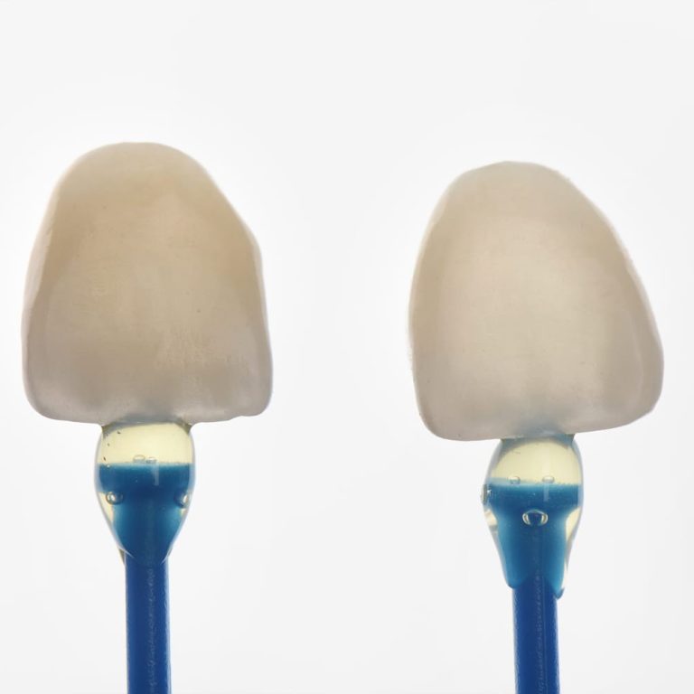 klinika_sypsena_dantu_laminates