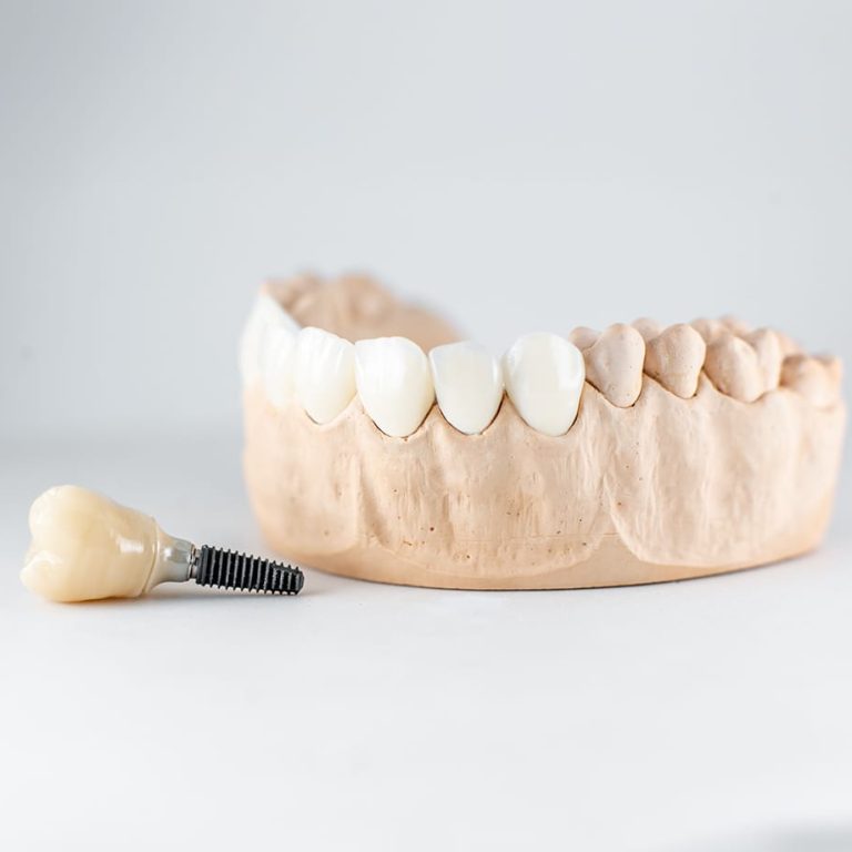 paslauga_Klinika-Šypsena-dantų-implantacija